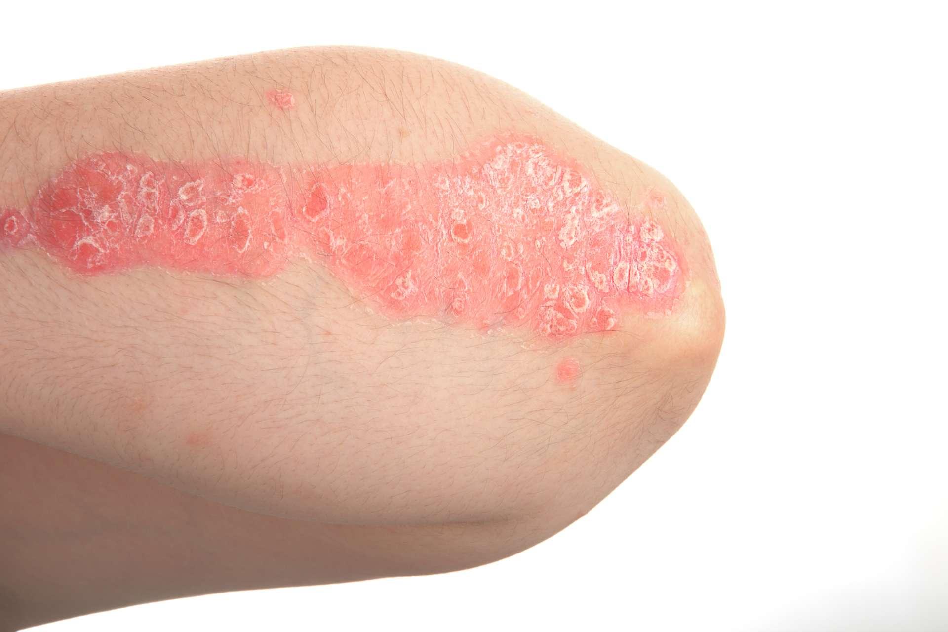 Psoriasis, dermatologische Erkrankungen.