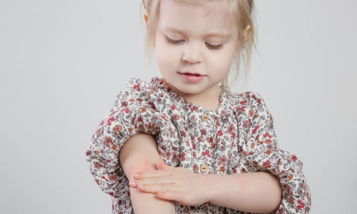 Toddler girl suffering from atopic dermatitis, close up image. Red and itchy skin. Eczema on kid's arm.