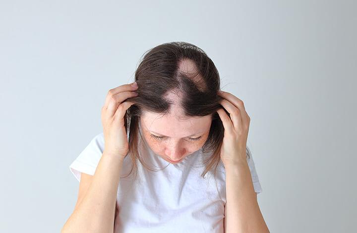 Junges Mädchen zeigt ihren Kopf mit ausfallenden Haaren: alopecia areata.