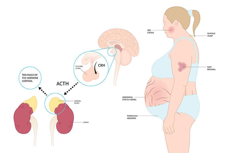 Illustration Cushing Syndrome