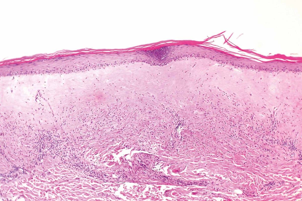 Lichen Sclerosus
