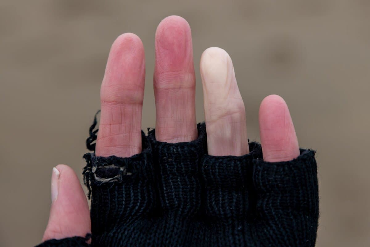Das Raynaud-Phänomen wird unter anderem von Kälte und Stress getriggert.