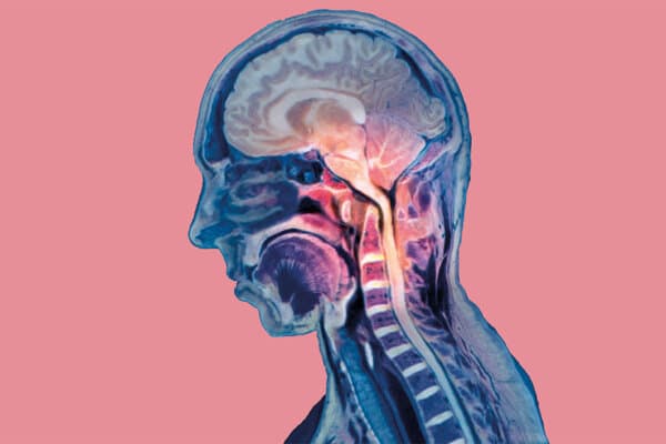 rachis cervical avec polyarthrite rhumatoïde